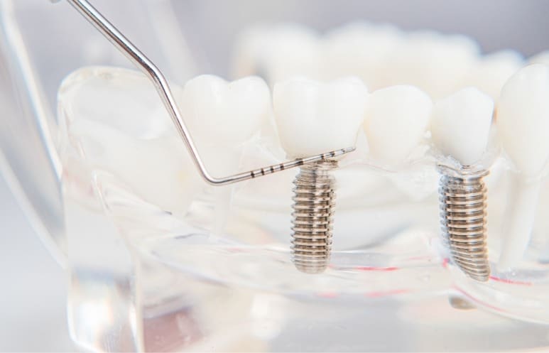 Qu’est-ce qu’un implant dentaire  ?